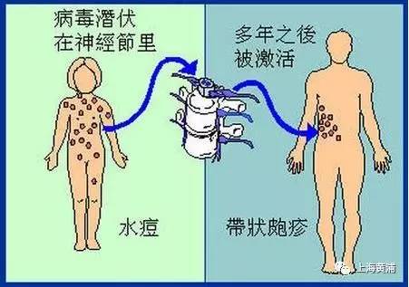 水痘带状疱疹怎么办