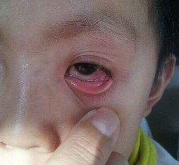 母婴 正文  急性出血性眼结膜炎俗称红眼病,传染性极强,人群普遍易感
