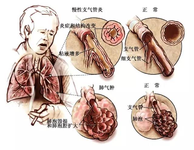 稍不注意就发病,比如慢性支气管炎(俗称慢支)