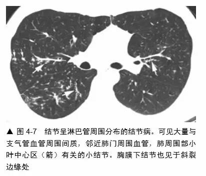 肺部受累的特征是呈斑片状,有些肺区可见成簇的肉芽肿,而其他区表现