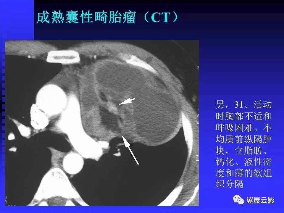 纵隔囊性肿块影像学