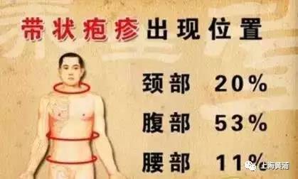 水痘带状疱疹怎么办