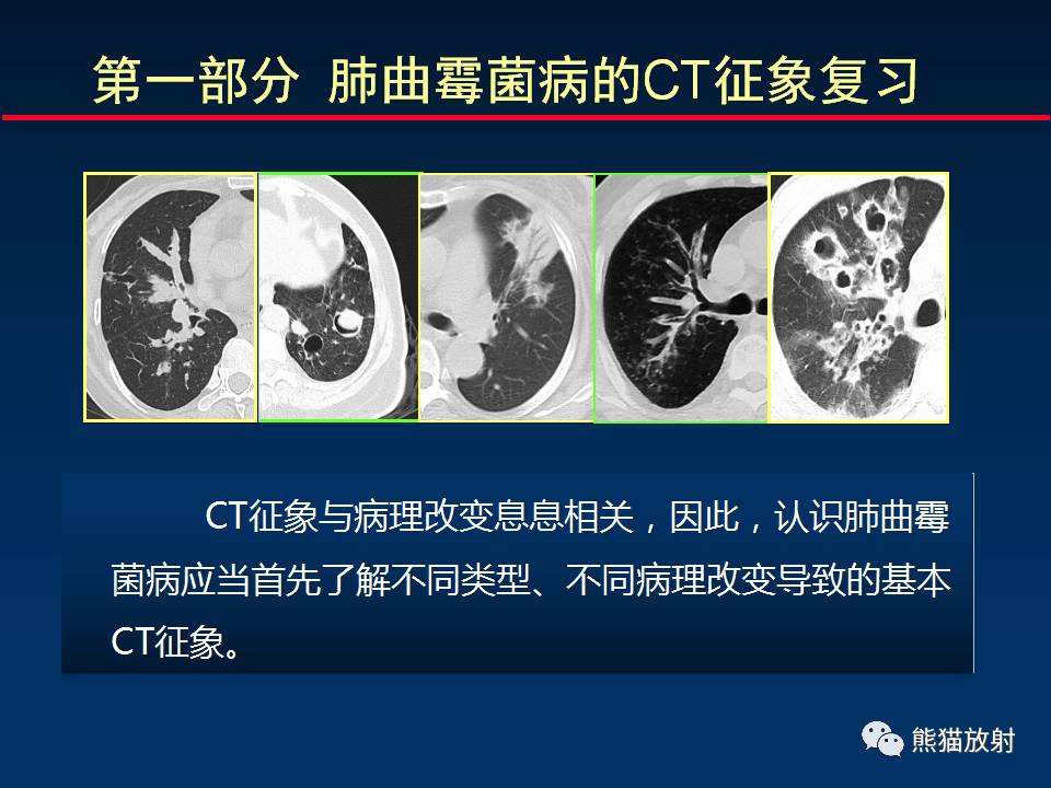 【柳澄讲坛】小儿肺曲霉菌病相关ct表现分析