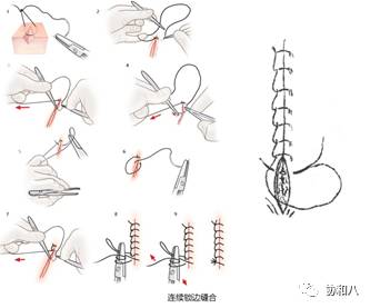 「8」字缝合(8-character-pattern suture)此方法为双间断缝合,缝扎