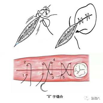 临行密密缝不同缝合方法特点和适用条件上一页手册协和八