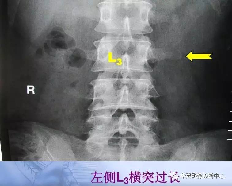 【影像基础】第三腰椎横突综合征,你忽略了吗?