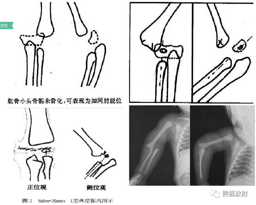 骨骺分离(有或无移位,多不引起生长障碍)ii型:骨骺分离伴干骺端