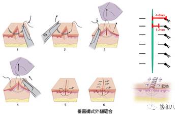 垂直褥式外翻缝合( vertical mattress  everting suture) 此方法