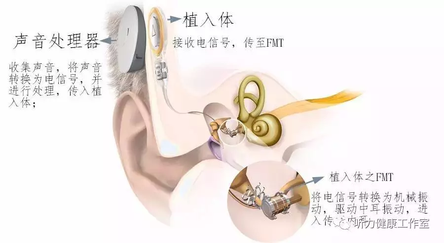 (固定于砧骨柄上的fmt 工作原理 听觉处理器的麦克风收集声音.