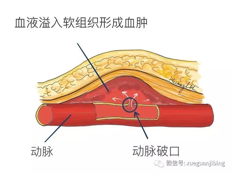 假性动脉瘤—一个股动脉穿刺无法回避的话题