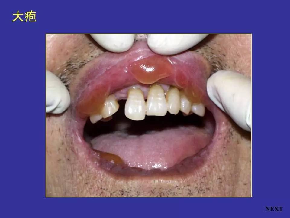多图连载一正常口腔黏膜及常见病损图