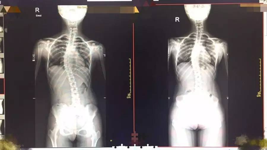 x光结果显示cobb角改善十度