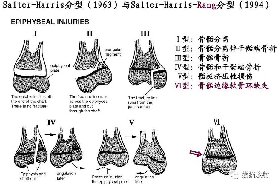 急诊骨骺损伤的分型及影像表现