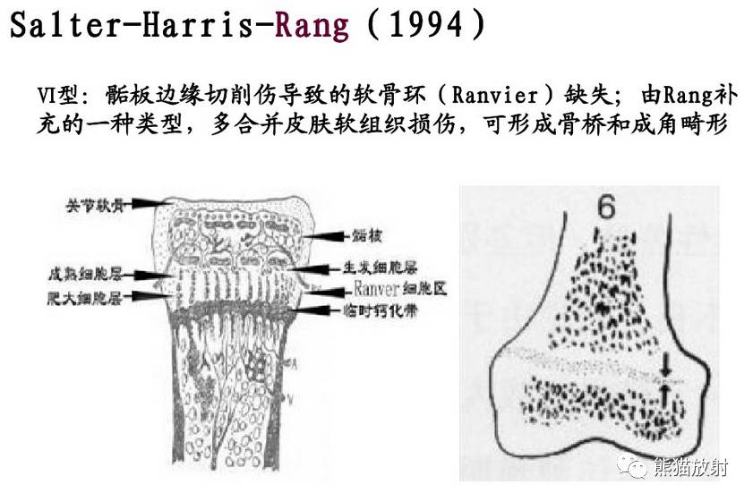 急诊骨骺损伤的分型及影像表现