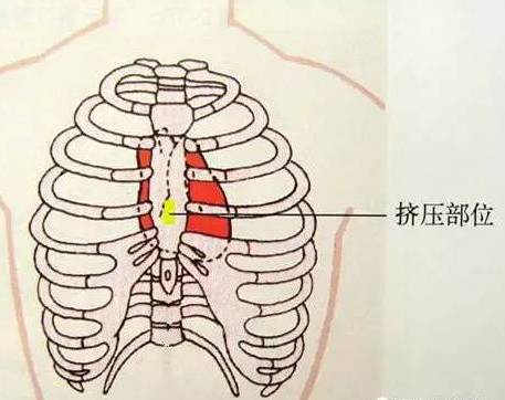 部位不在中线:则可能引起肋骨骨折,肋骨与肋软骨脱离,血气胸等并发症