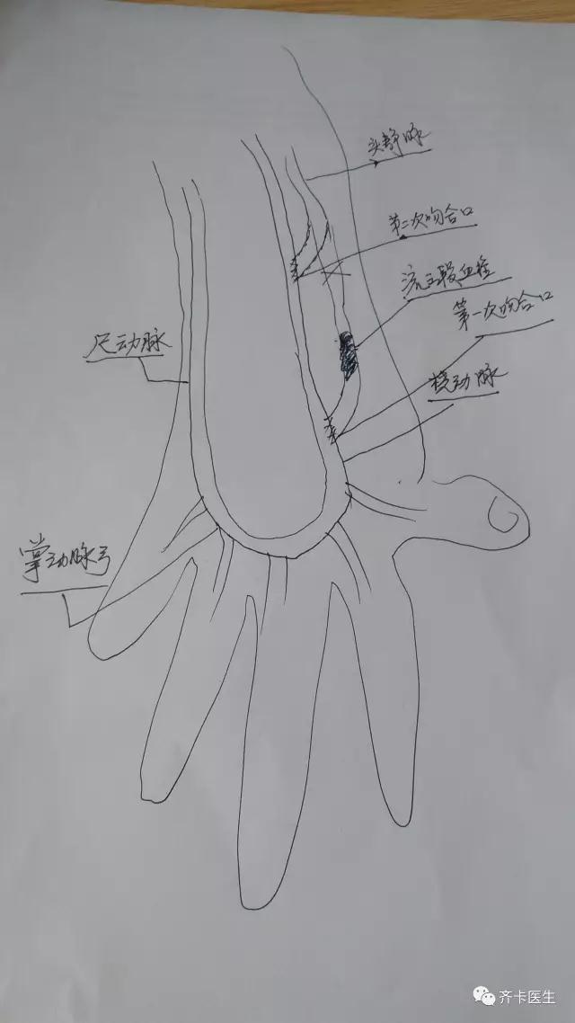 内瘘术后,透析中手指麻木疼痛进行性加重是咋回事?