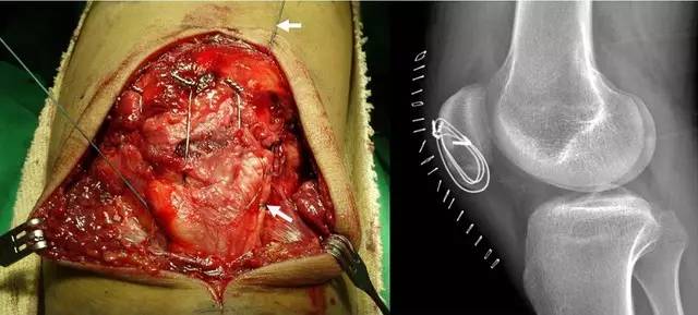 手术技巧髌骨下极横行骨折的极佳固定方法