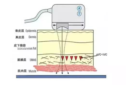 美容超声刀原理是什么_白带是什么图片(2)