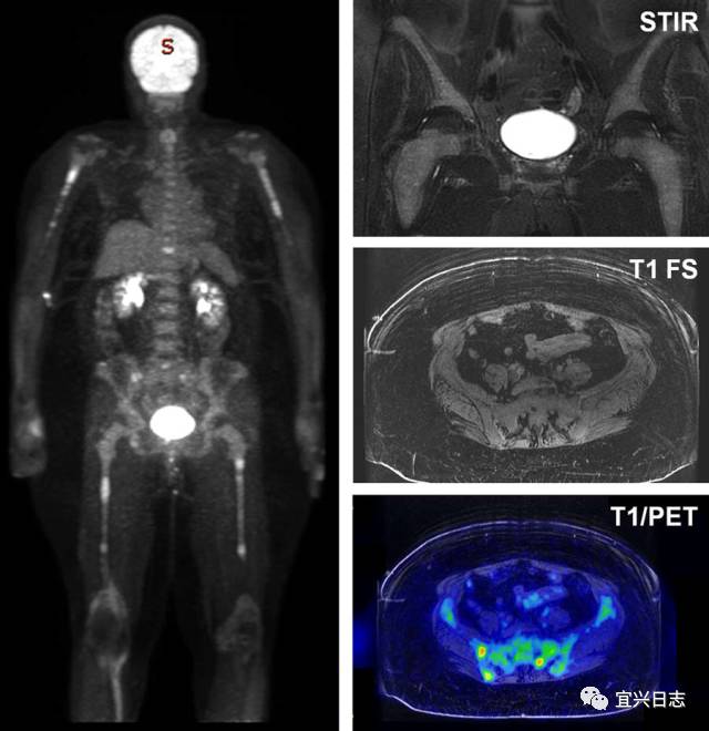 ### Understanding PET CT Side Effects: What You Need to Know