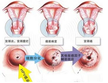 ⑥hpv感染的发生先于子宫颈癌.