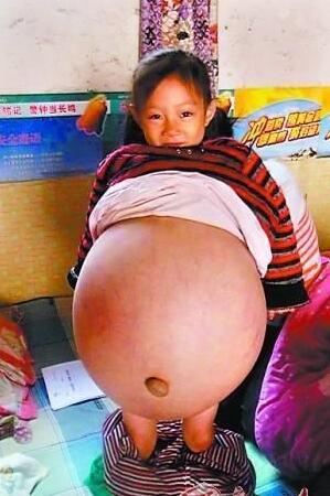 6岁小女孩肚子大的像孕妇,去医院检查后,把妈妈直接吓