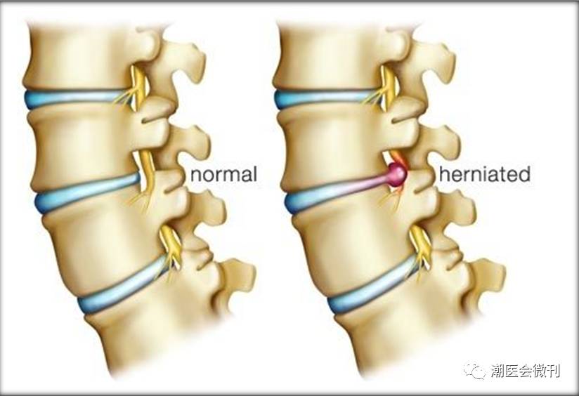 【潮医原创】养病,养病,腰椎间盘突出症不用养!