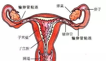 解决输卵管粘连,让孕育"一路畅通"