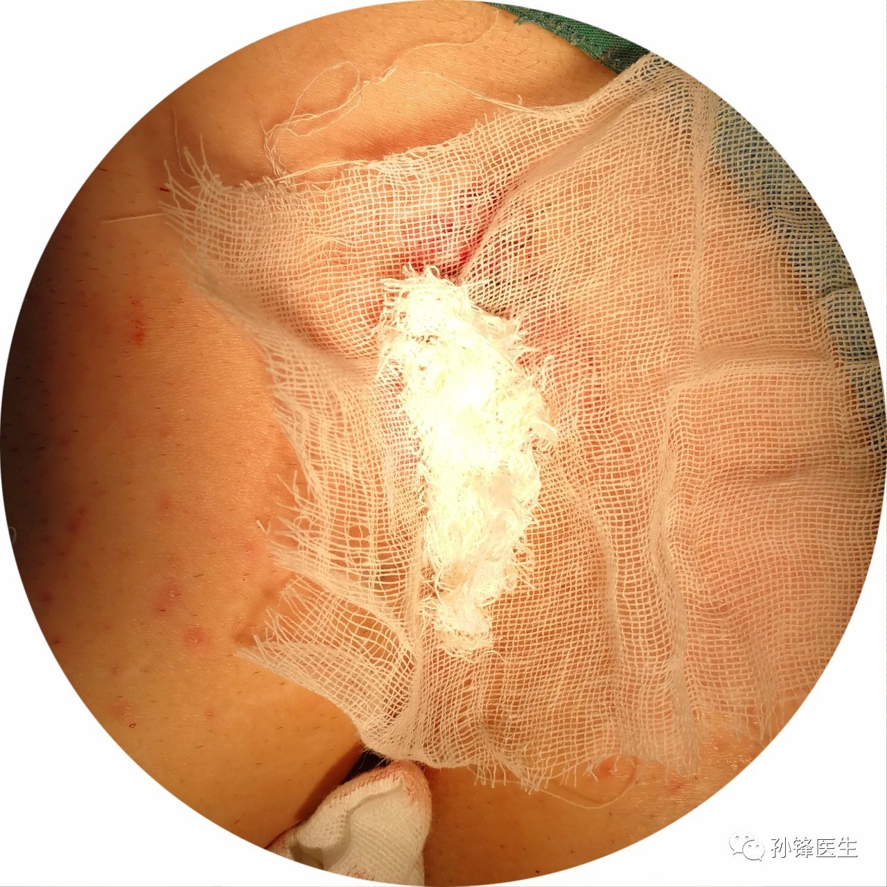 手术笔记|原位皮肤适形移植术(ssg)治疗骶尾部藏毛窦