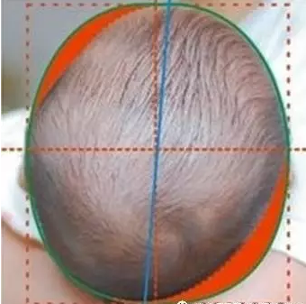 宝宝头型异常,一定要及时矫正
