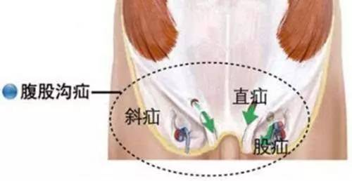 【健康】小洞不补大洞苦,老人发生