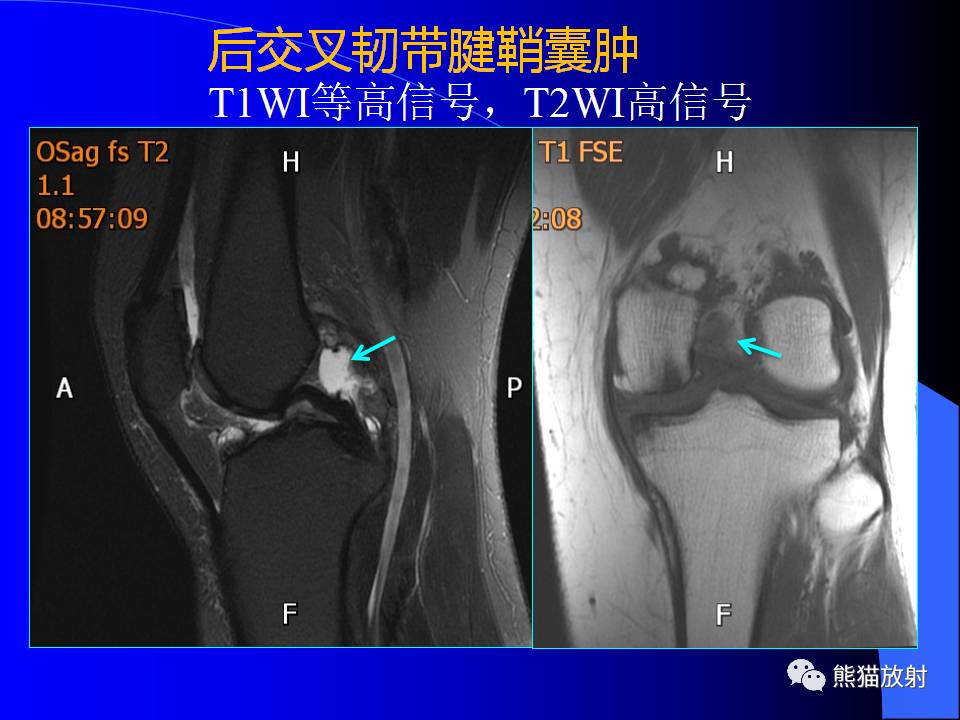 【专家讲座】膝关节周围囊肿mri表现(林祥涛)