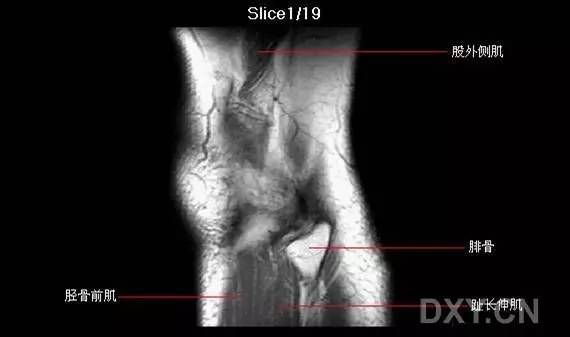 【解剖】膝关节系统解剖图 矢状mri 示意图