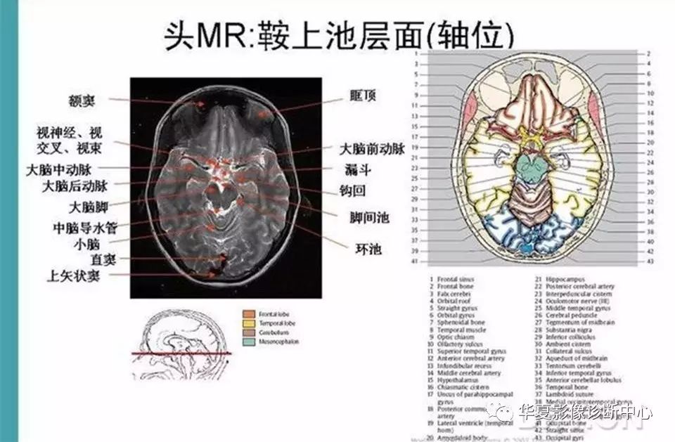 完整的头颅mri解剖值得收藏