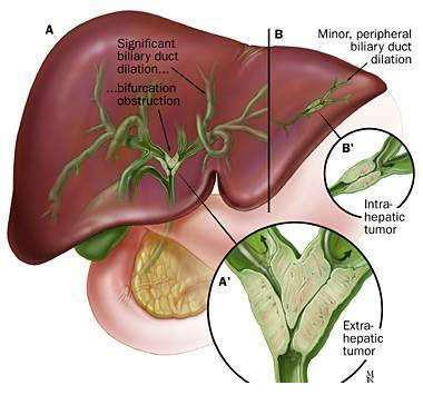 肝内胆管细胞癌肝叶切除