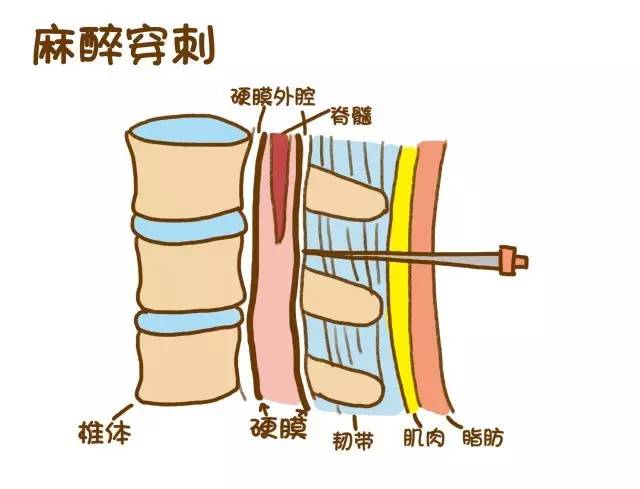 或者肚子太大,可能会造成穿刺困难,那么麻醉后也不可避免的造成一定