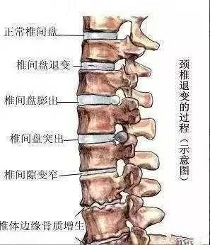 颈,腰椎常见疾病有腰肌劳损,颈椎病,腰椎间盘突出症: 腰肌劳损