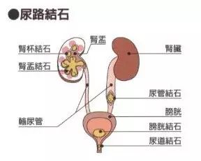 送到医院检查后,医生给出结果: 他患上了左侧输尿管结石, 还伴有左肾