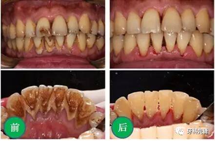 牙垢如果清除不去,就会慢慢演变为结石,给牙齿带来危害,最终引发牙周