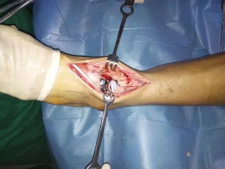 济宁市第一人民医院手足踝外科成功完成全踝关节置换术