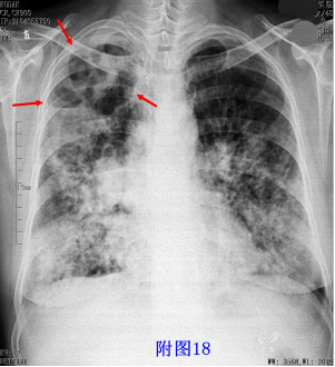 肺结核:右肺上叶多发空洞,内可见气液平;可见肺尖帽征