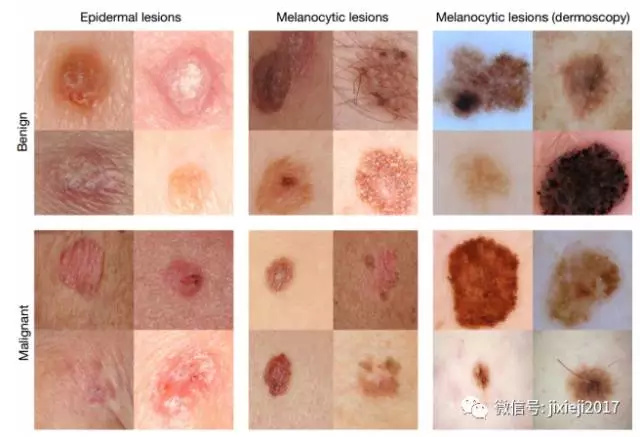 斯坦福大学用人工智能来诊断皮肤癌,准确率达91%