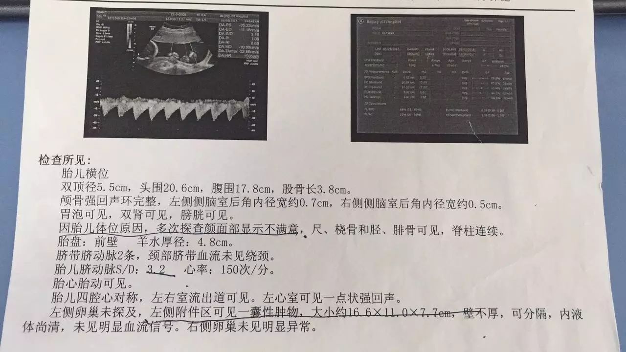 医患一家妇产科成功完成一例孕中期巨大卵巢肿瘤腹腔镜手术