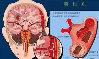 68例老年性脑萎缩并发脑出血的治疗体会