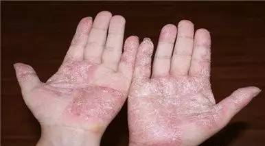 3 疾病简析 手癣俗称"鹅掌风",皮损与足癣大体相同,手癣多为水疱型和
