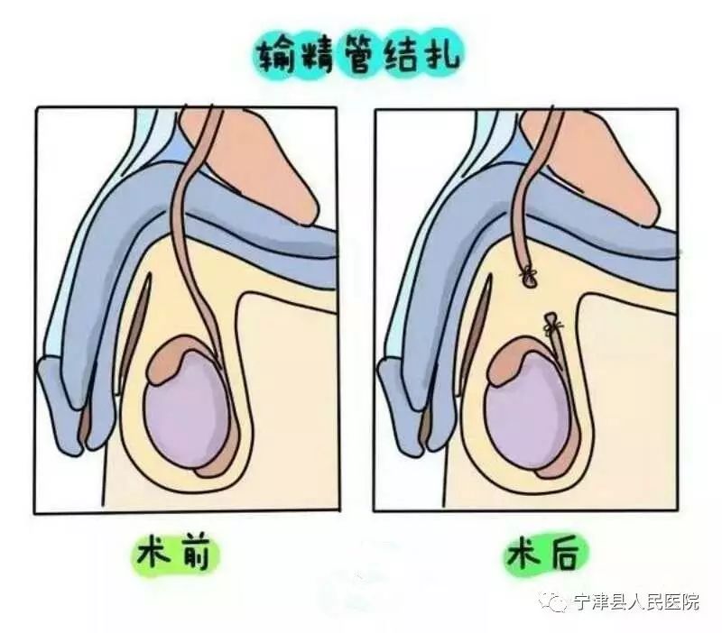 产后避孕之新妈咪要当心