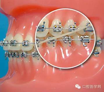 放大的图显示3类牵引-其他类型的牵引,比如三角形牵引