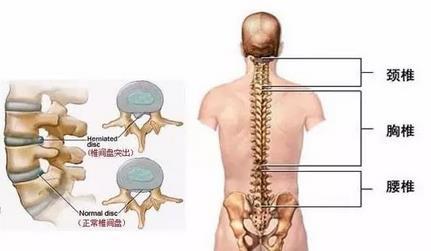 不正确坐姿腰椎受力高达280腰椎间盘突出症您关心的问题都在这