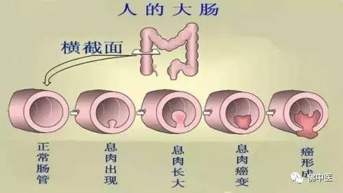 因为肠息肉有可能是癌变前的一个信号灯.