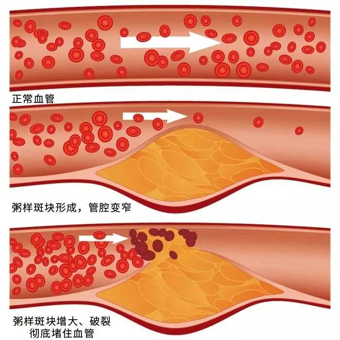 堵塞更严重 斑块游离到了心脏,引起心血管阻塞——在发生急性血栓堵塞