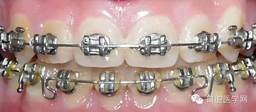 牙齿矫正科普帖:正畸牙套装置部件详解